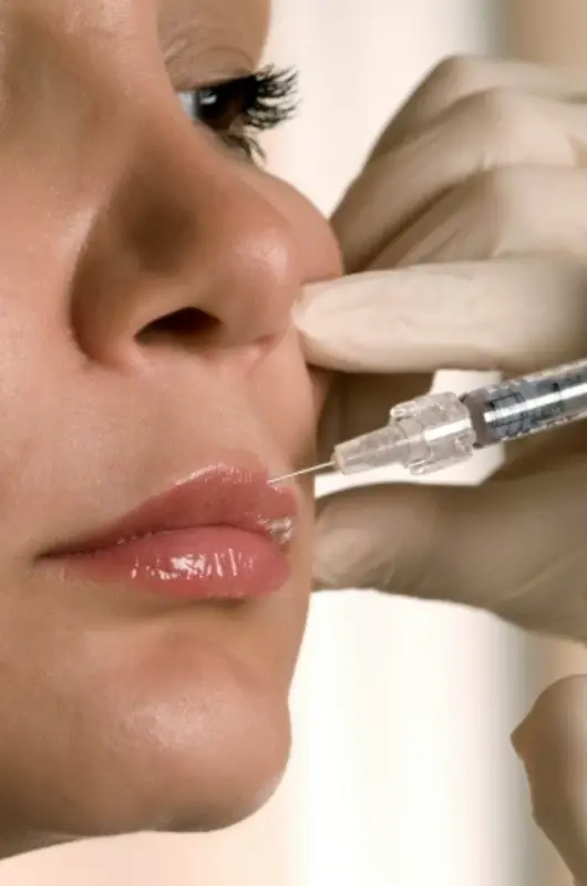 Correction de la bouche par injection d’acide hyaluronique - Clinic 26