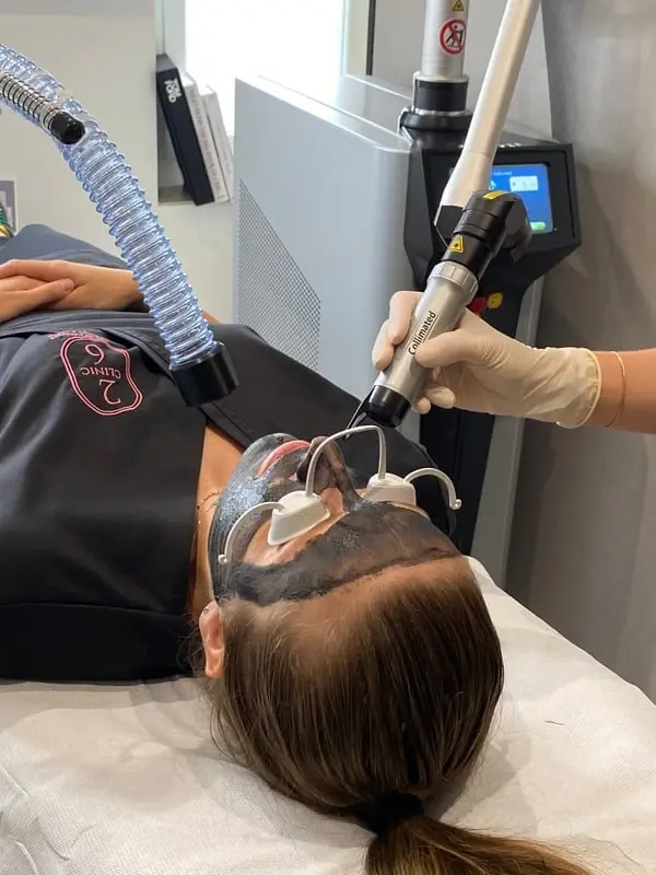 Femme en soin carbon peel pour éliminer les impuretés de sa peau - clinic 26